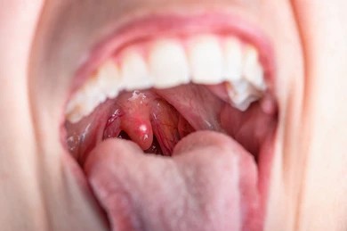close-on-canker-sores-inflammation-260nw-1982845658 Close-up photo of patient's tongue before lingual nerve injury surgery.