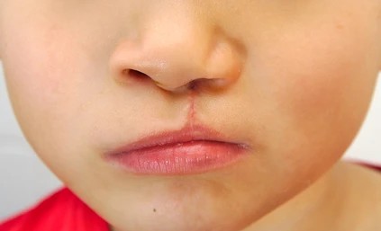 Child with cleft lip undergoes surgery to improve aesthetics and functionality.