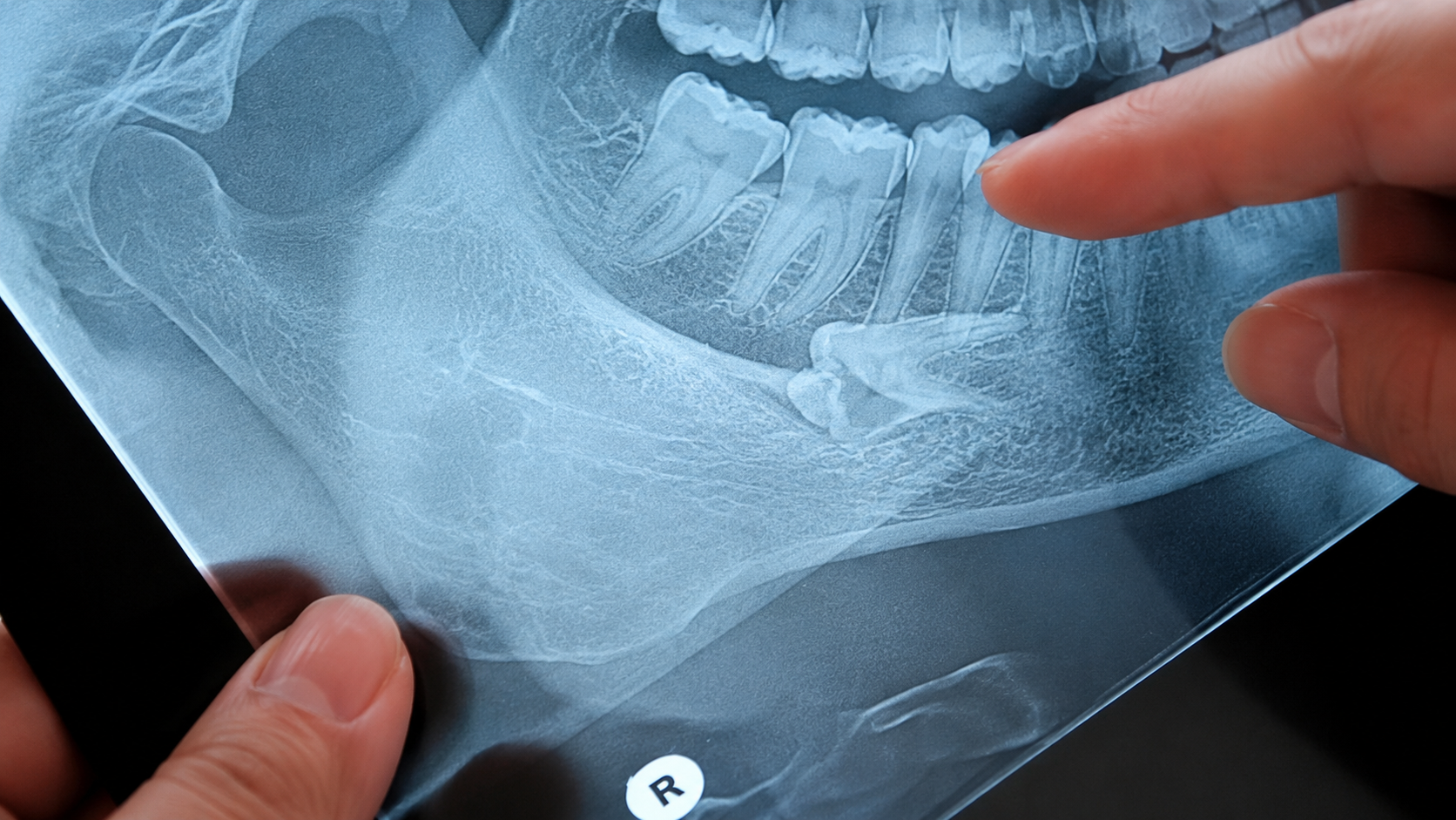 X-ray of wisdom tooth that needs removal X-ray of wisdom tooth that needs removal.
