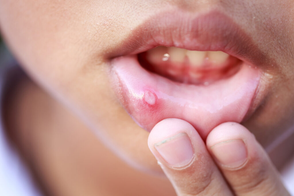 Woman pulls down her lip to show a mouth sore.